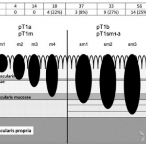 淋巴结浸润的早期食管腺癌应接受外科手术治疗