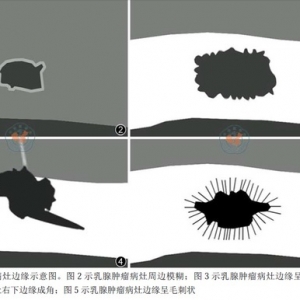 NCCN 2012乳腺癌筛查和诊断指南解读