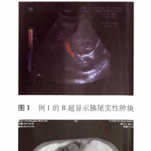 胰母细胞瘤二例