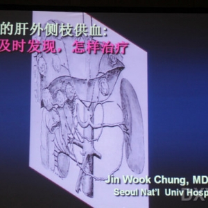Jin Wook Chung教授：肝癌经肝外动脉供血的类型及治疗策略