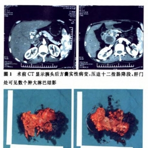 肝移植术后胰十二指肠切除术一例报道及文献复习