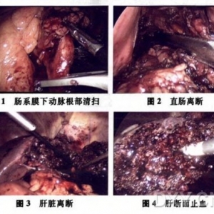 完全腹腔镜下低位直肠Dixon术+左半肝 切除治疗直肠癌伴左肝转移一例报告