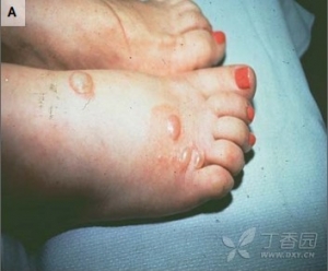 如何处理蜜蜂和蚂蚁叮咬过敏