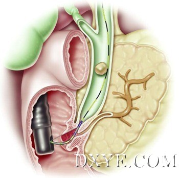 ERCP-Figure-2.png