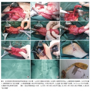 无需还纳的保护性回肠造口技术的再优化