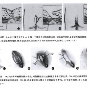 藏毛窦转移皮瓣技术研究进展