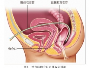 直肠癌术后吻合口漏的诊断与治疗进展