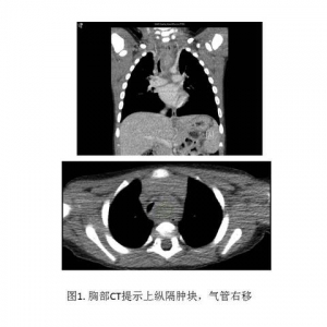 一片树叶引发的小儿气管食管瘘