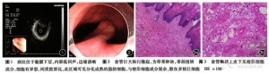 内镜下切除食管巨大非典型性脂肪瘤/高分化脂肪肉瘤一例