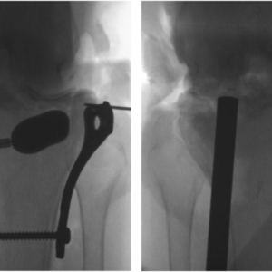 手术技术：复位胫骨平台塌陷关节面的方法