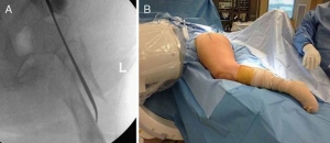手术技术：转子下骨折侧位髓内钉置入方法