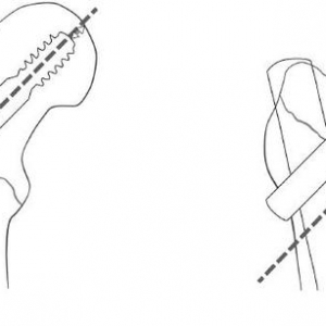 参考距-尖顶距是预测头颈螺钉切出的重要因素