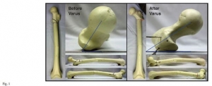 JBJS：股骨截骨旋转角度的定位法