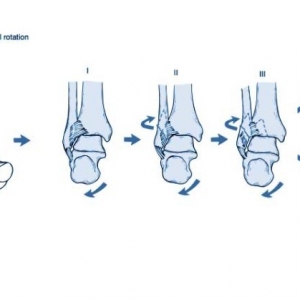 踝关节骨折 Lauge-Hansen 分型 帮你彻底整明白