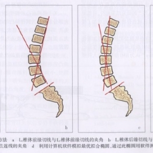 腰椎前凸的相关研究进展