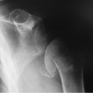 反式肩关节置换治疗肱骨近端骨折不愈合