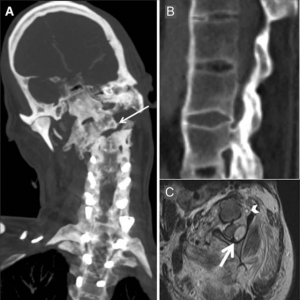 强直性脊柱炎引起的颈椎骨折1例