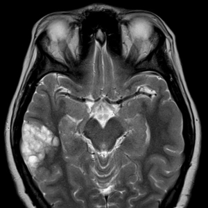 病例学习：神经上皮肿瘤
