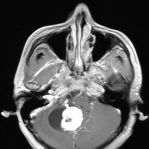 肿瘤横行：希佩尔-林道综合征