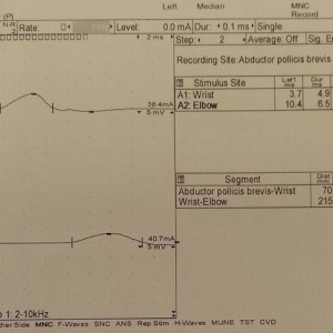 罕见副肿瘤综合征：直肠癌也可累及周围神经