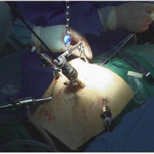 非气腹腹腔镜辅助经膈食管癌切除术疗效有待证实