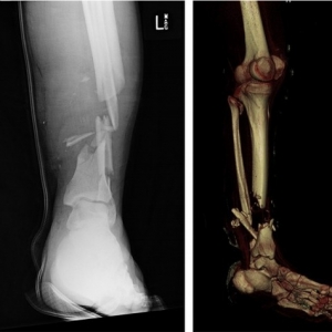 下肢创伤性骨缺损的诊治