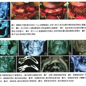 骨质不良下颌骨骨折的手术治疗