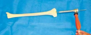 手术技术：微创方法取髌骨上入路胫骨髓内钉