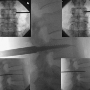 手术技术：经皮克氏针引导下椎弓根螺钉置钉