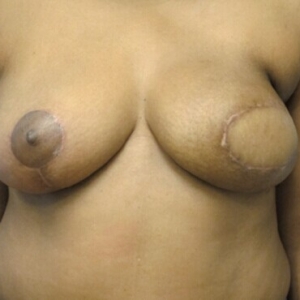 乳腺癌术后同期完成乳房重建和双乳对称手术安全有效