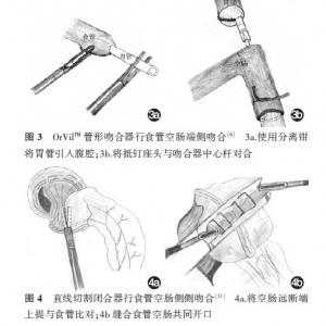 全腹腔镜全胃切除胃癌根治术消化道重建方式的探讨