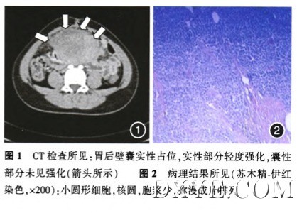 胃原始神经外胚层肿瘤一例.png