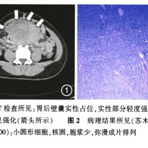胃原始神经外胚层肿瘤一例