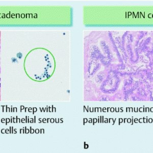 穿刺引导下共聚焦内镜可用于诊断胰腺浆液性囊腺瘤