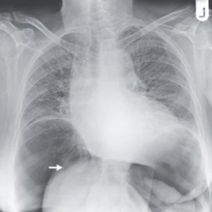 病例学习:气腹引起的肝旋转