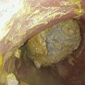 钡剂凝块引发便秘一例（视频）