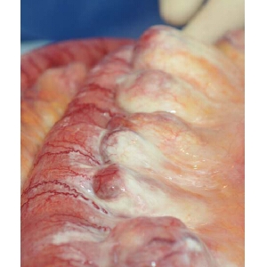 自发性小肠扭转引发乳糜性腹水一例