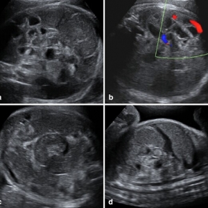 胎儿肠扭转一例