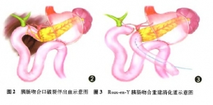 胰十二指肠切除术后出血的治疗策略