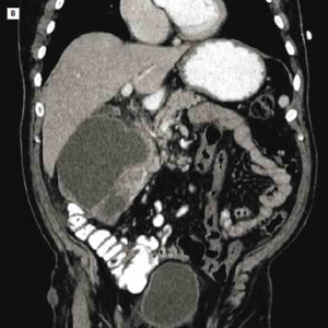 疑难杂症：遗传性皮肤病伴出血性腹部肿块