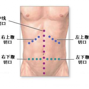 组合预防成为降低结直肠手术切口感染的有效途径