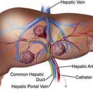 症状性多囊肝术后长期使用奥曲肽可有效减少复发