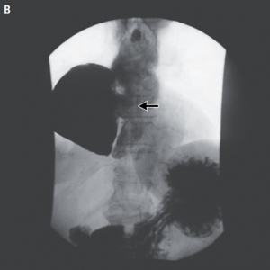 NEJM：膈上食管憩室一例