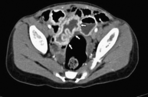 Surgery中国病例：4岁患儿空肠管状重复