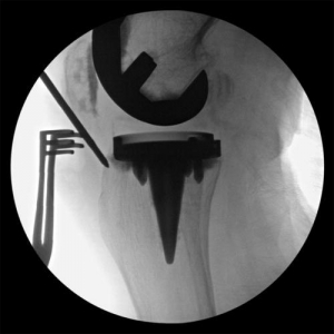 髓内钉治疗TKA术后远端胫骨骨干骨折