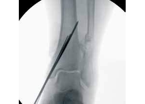 手术技术：双皮质螺钉固定治疗内踝骨折