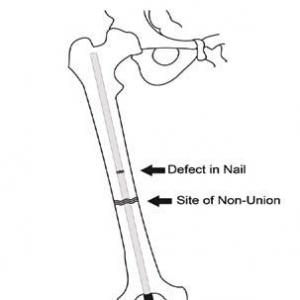 手术技巧：取出断裂逆行髓内钉的方法