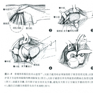 手术技术：髋关节外科脱位后髋关节内手术入路