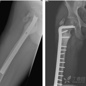 经典病例：联合技术处理股骨近端感染性骨不连