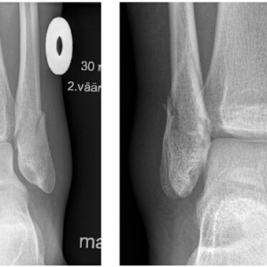 MRI能准确评估旋后外旋型踝关节骨折的关节稳定性吗？